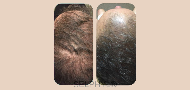 PRFM for Hair Loss - before and after pelham